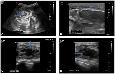Case report: A rare case of simultaneous necrotizing fasciitis of the breast and forearm